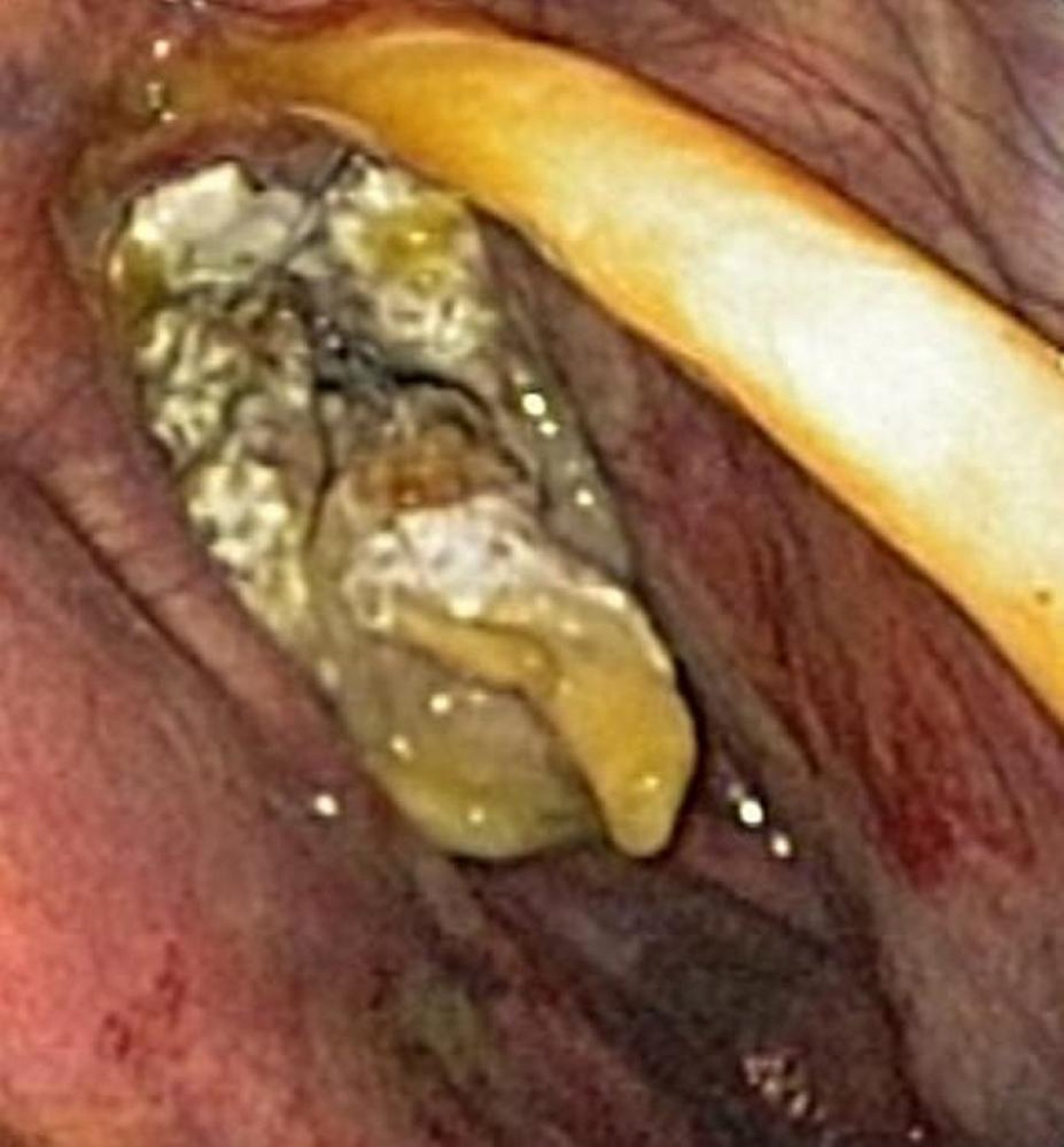Dysphagia of infectious origin in a horse with guttural pouch mycosis