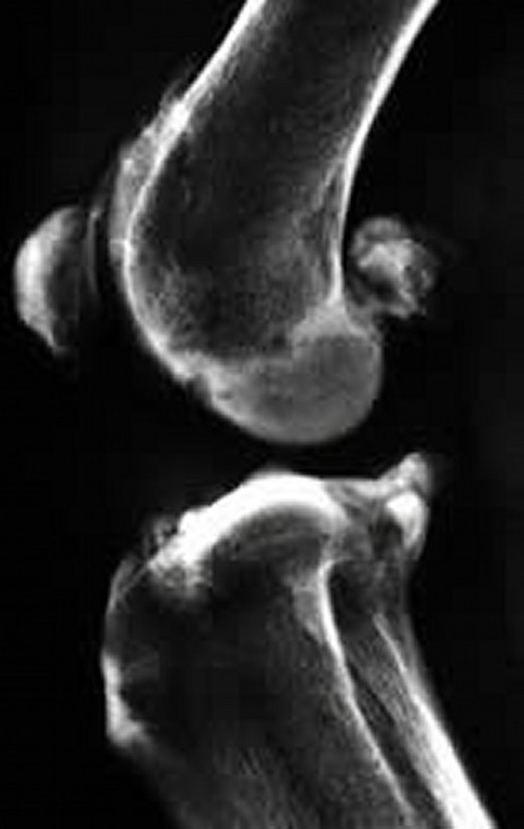 Enfermedad articular degenerativa, radiografía (lateral)