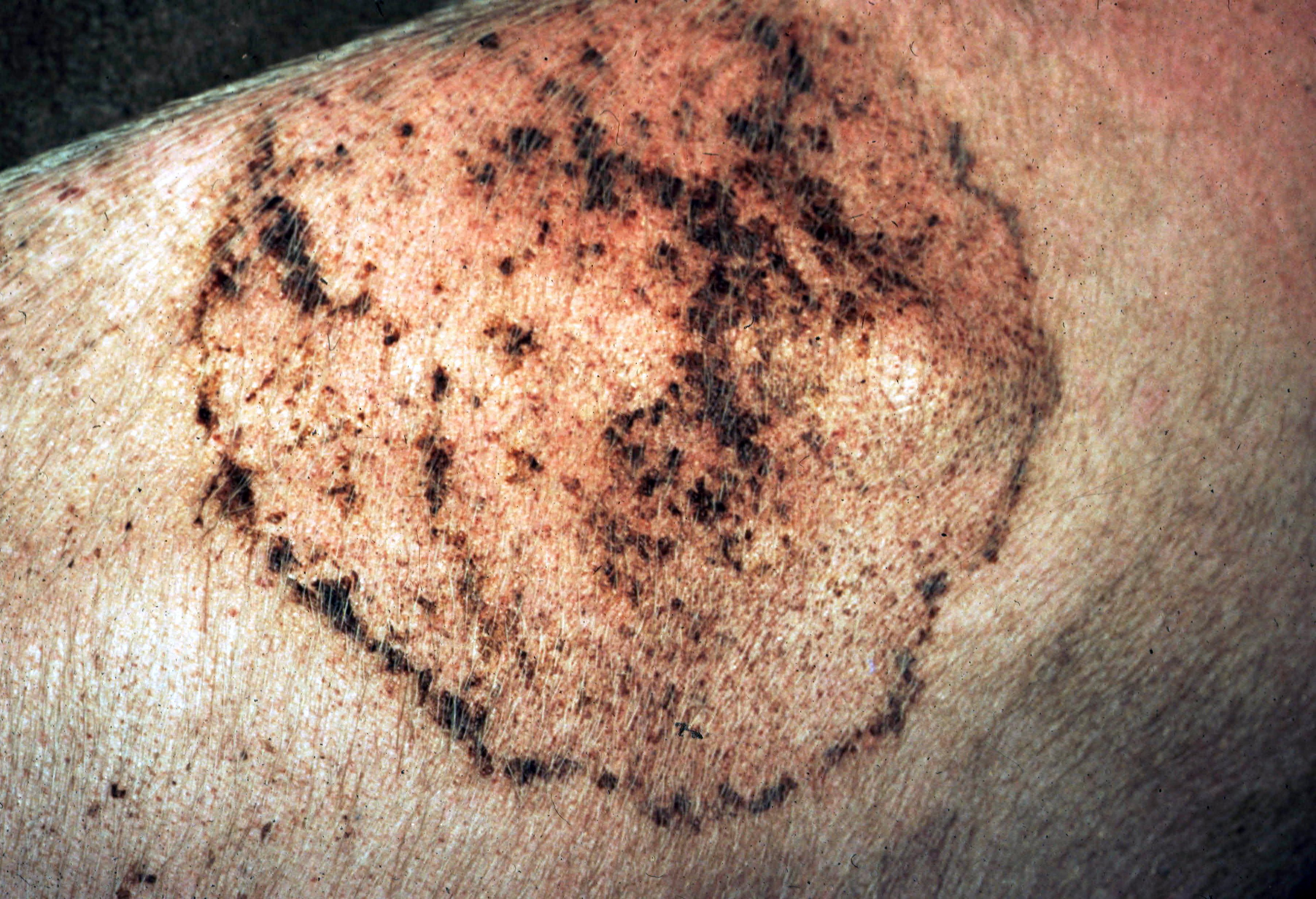 Dermatofitosis, cerdos