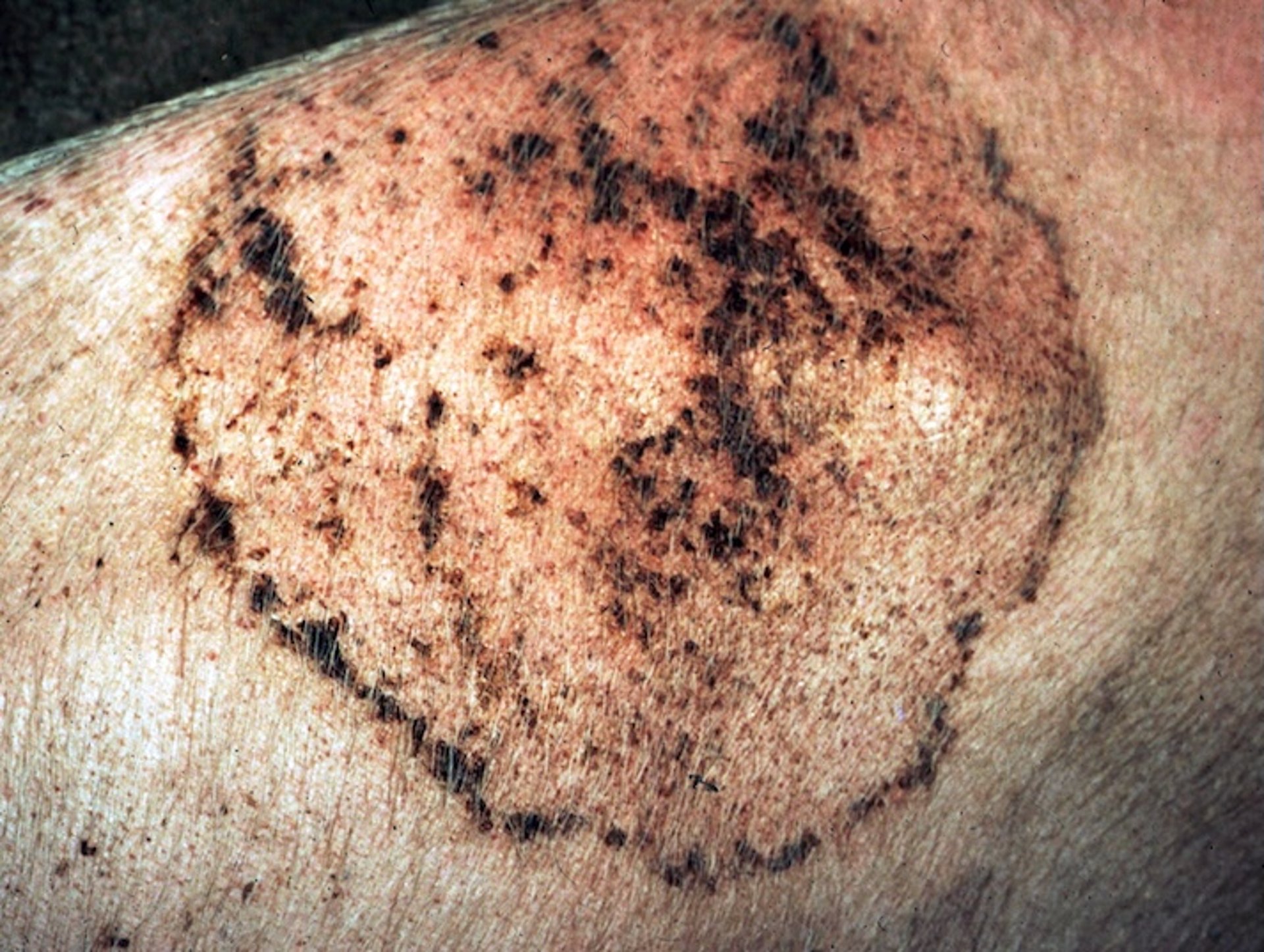 Dermatophytosis, pig