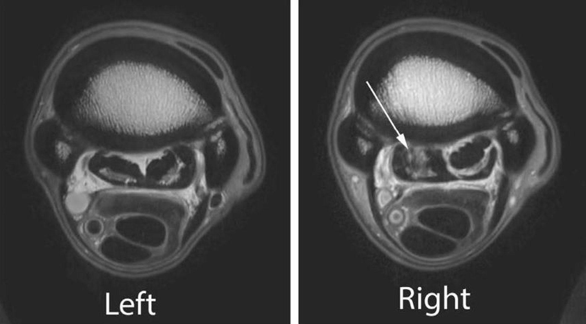 Desmitis, proximal suspensory ligament, MRIs, horse