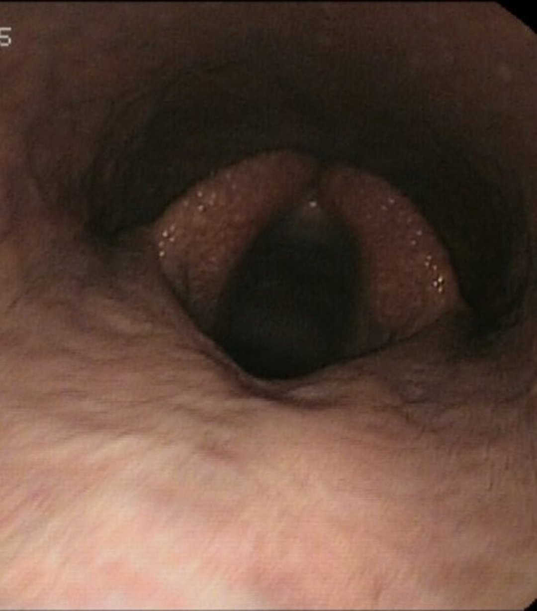 Dorsal displacement of the soft palate, horse