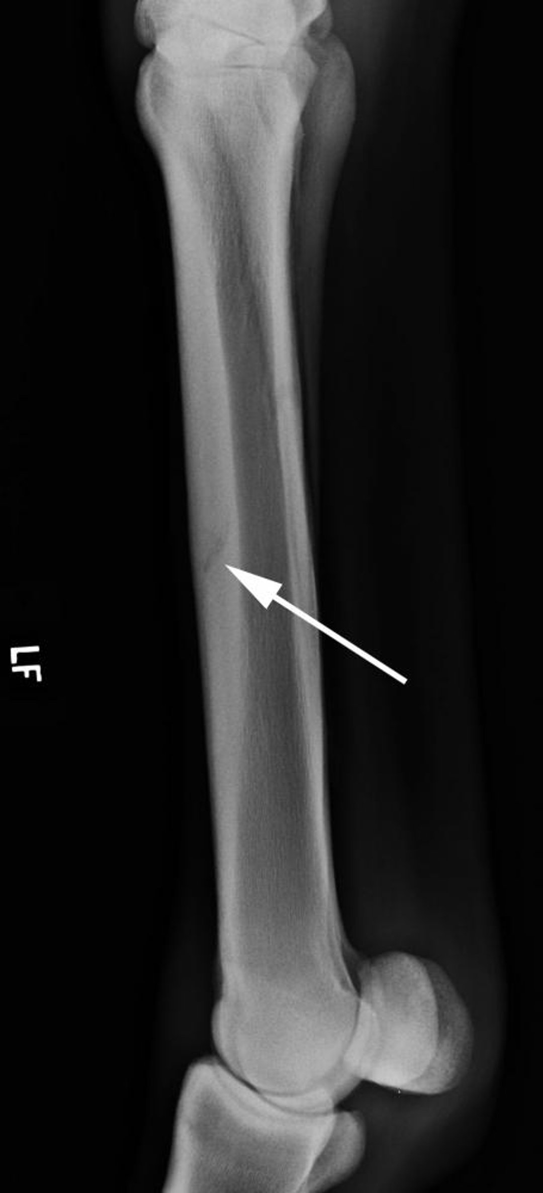 Fractura cortical dorsal por estrés del tercer metacarpo, radiografía, caballo