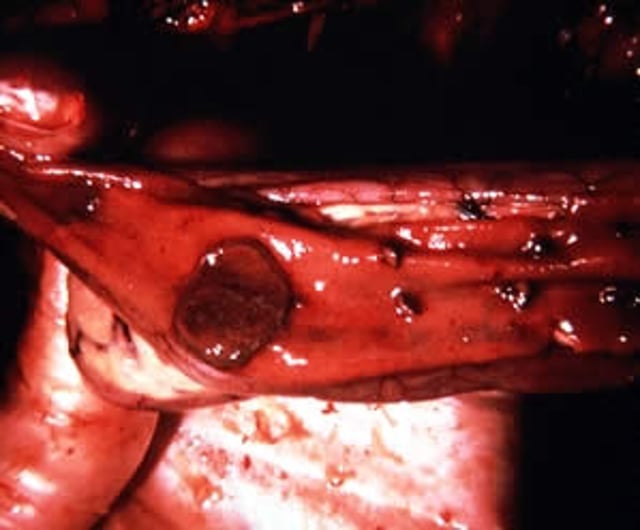 Duck viral enteritis, intestine