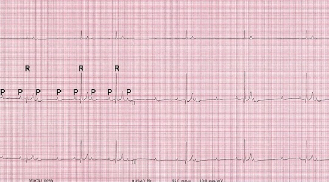 Image:ECG, high-grade second-degree atrioventricular (AV) block, dog ...