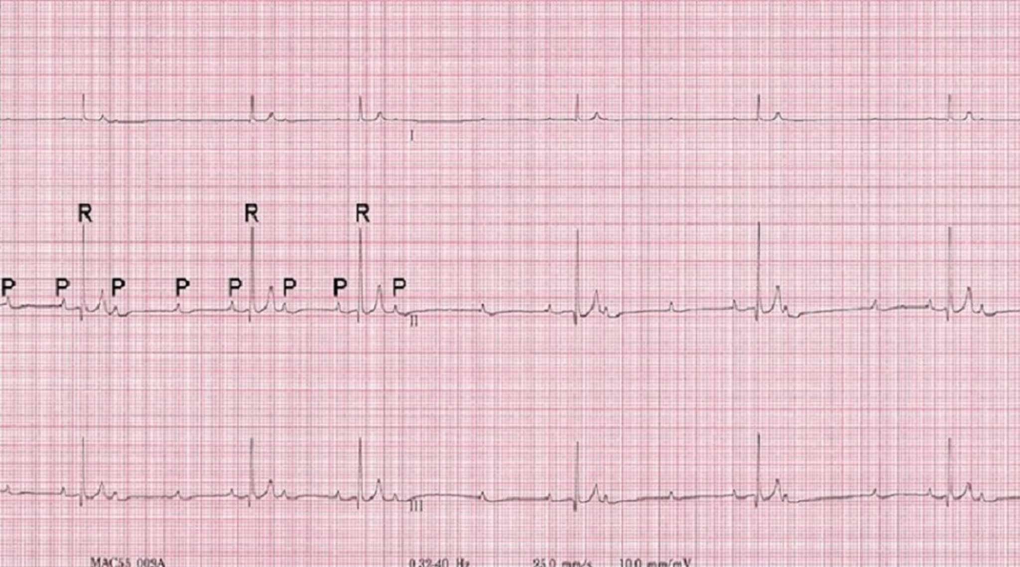 wandering pacemaker in dogs