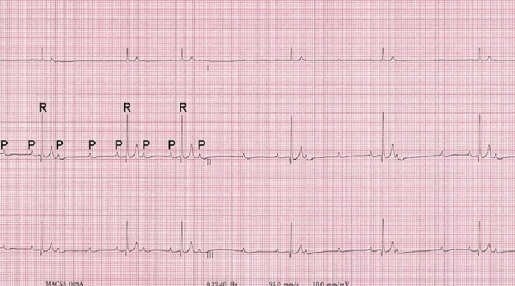 ECG, high-grade second-degree atrioventricular (AV) block, dog