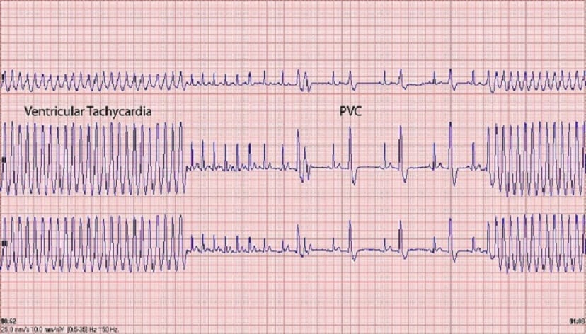 Image:ECG, malignant ventricular tachycardia, Boxer-MSD Veterinary Manual