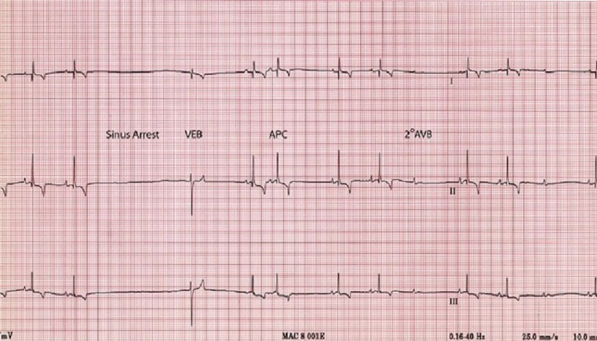 ECG, sinus arrest, dog