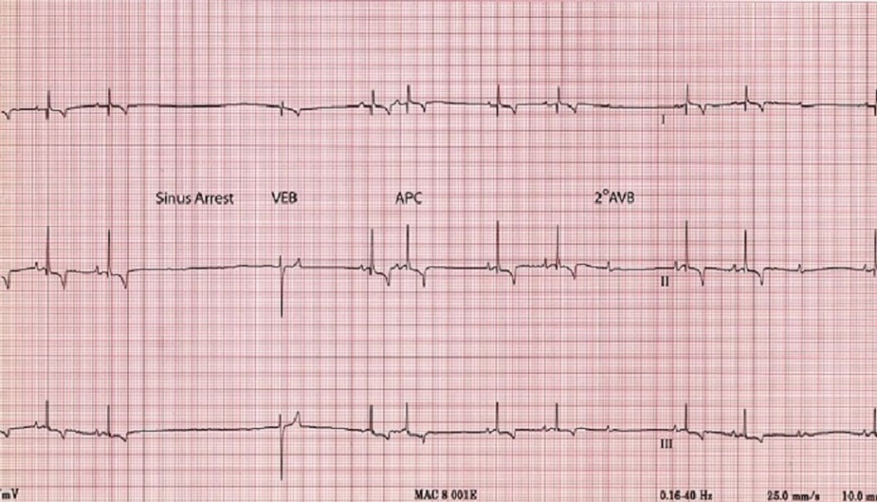 ECG, sinus arrest, dog