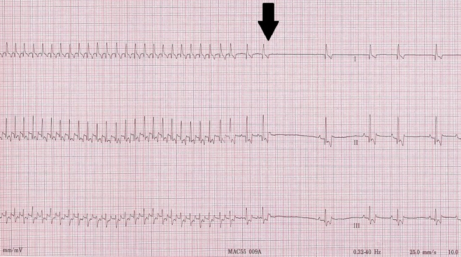 ECG, supraventricular tachycardia, dog