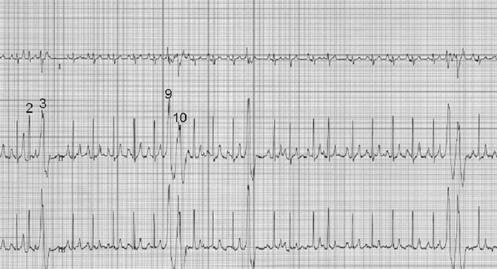 ECG, ventricular premature complexes, dog