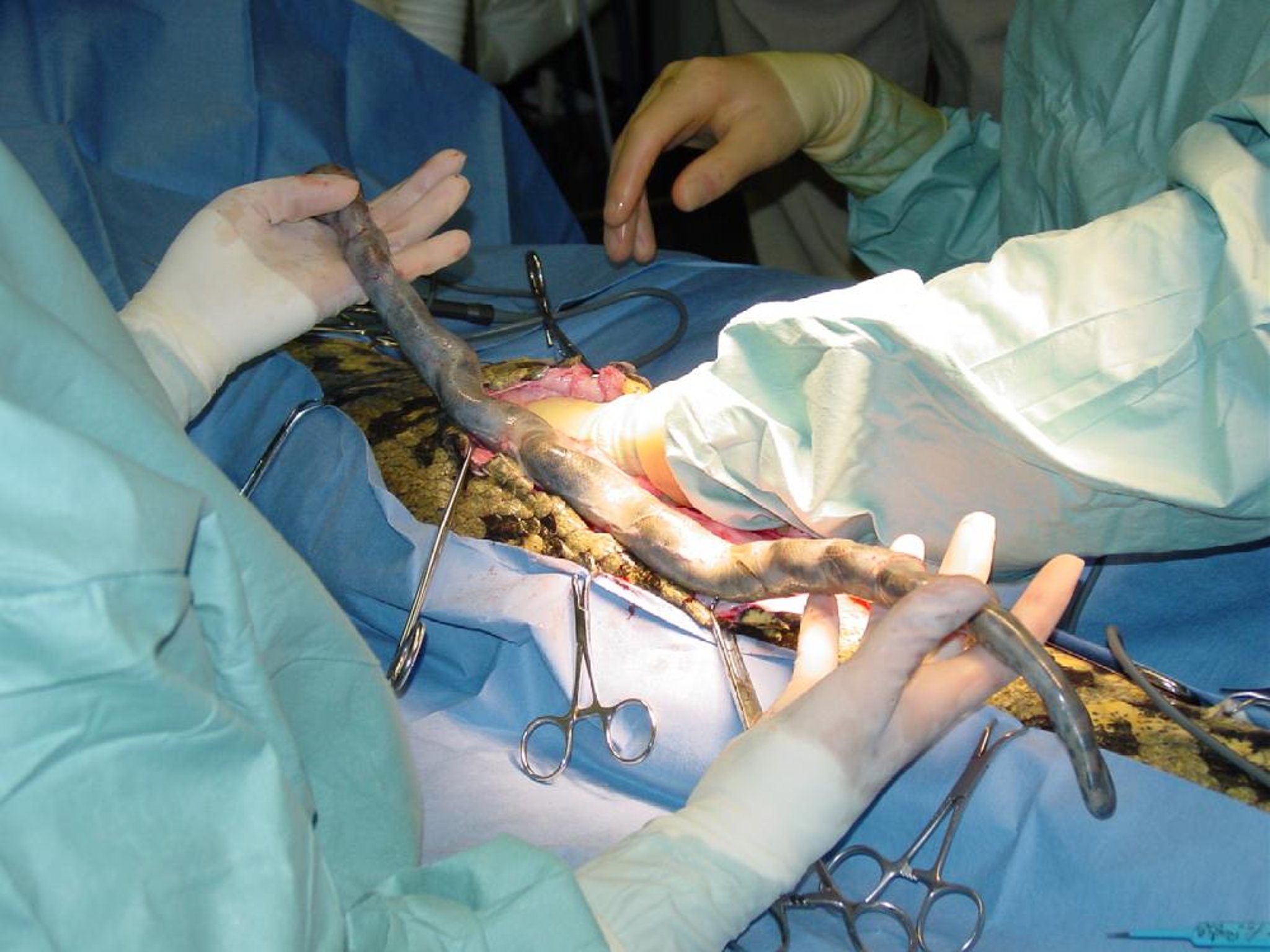 Mummified, ectopic fetus removal, anaconda