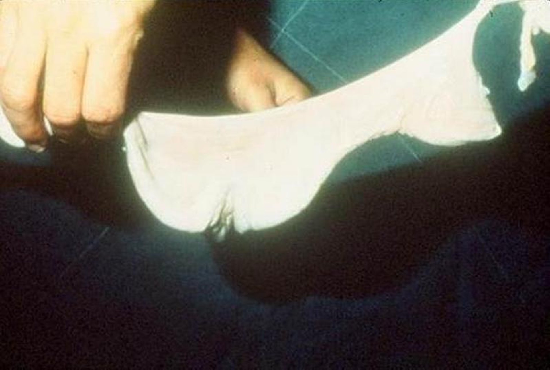 Palpation of endometrial folds, mare