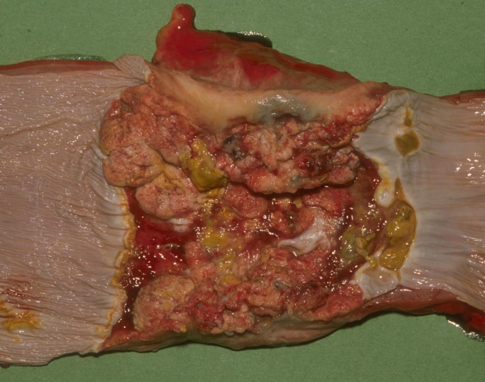 Esophageal squamous cell carcinoma, horse