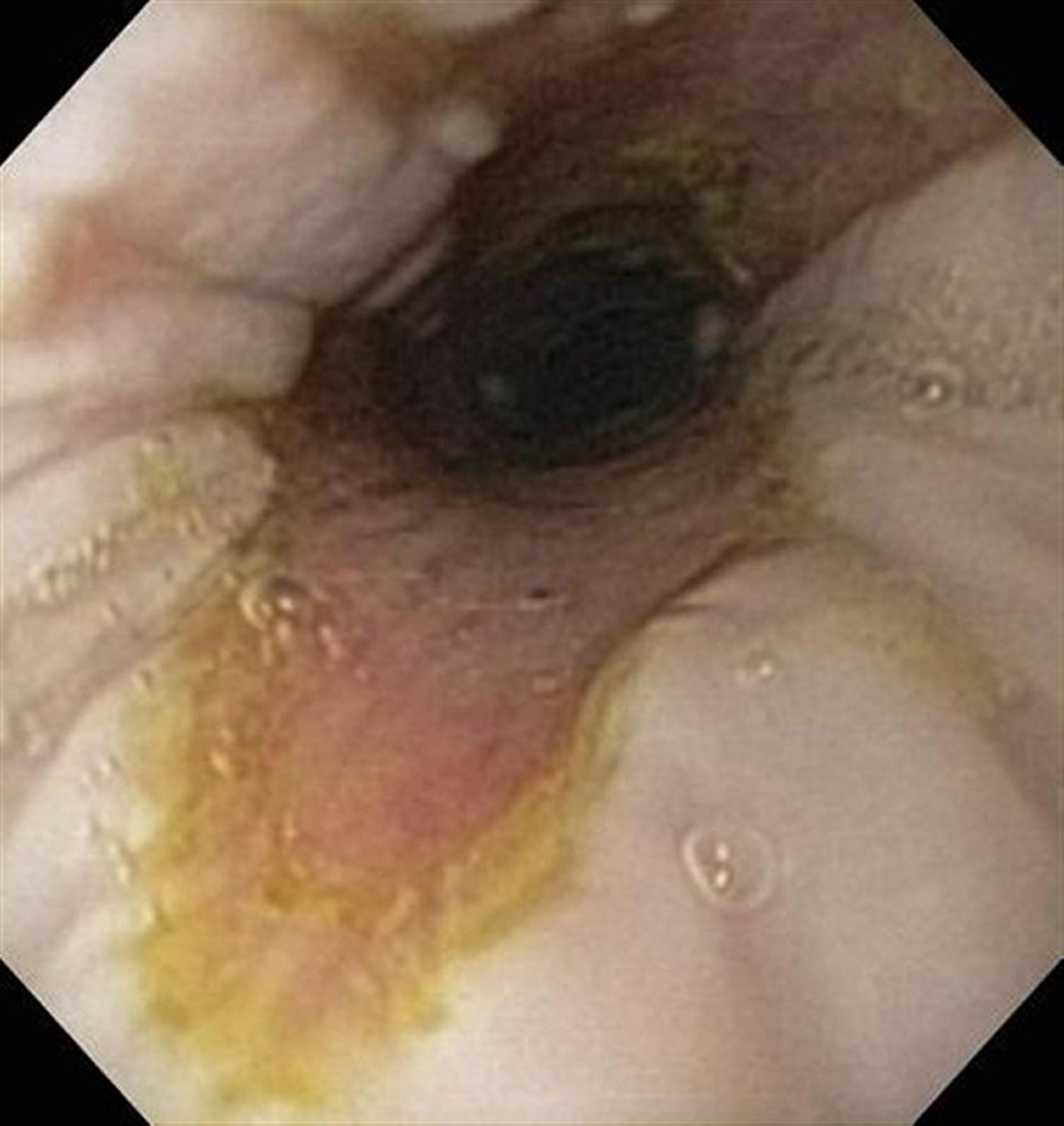 Esophageal ulceration after esophageal obstruction, horse