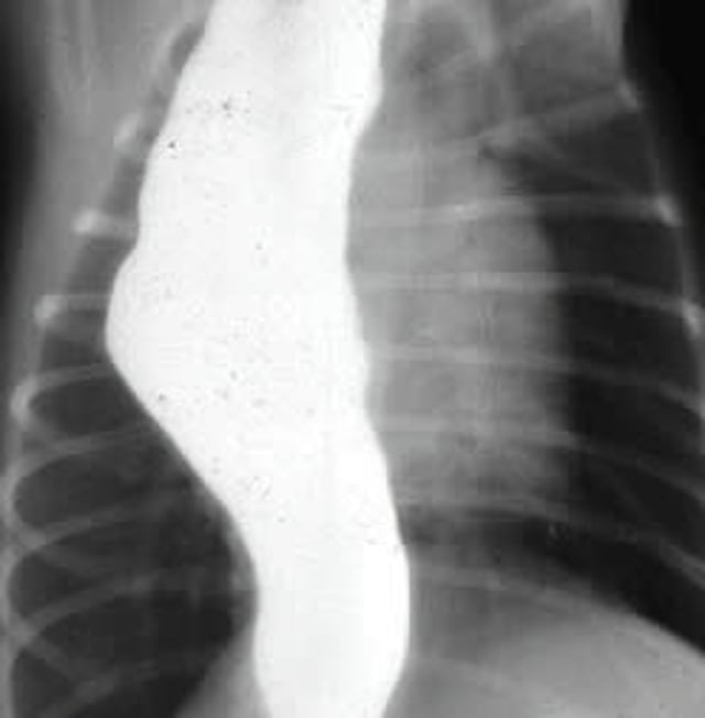 Dilatation of the esophagus, ventrodorsal view, dog
