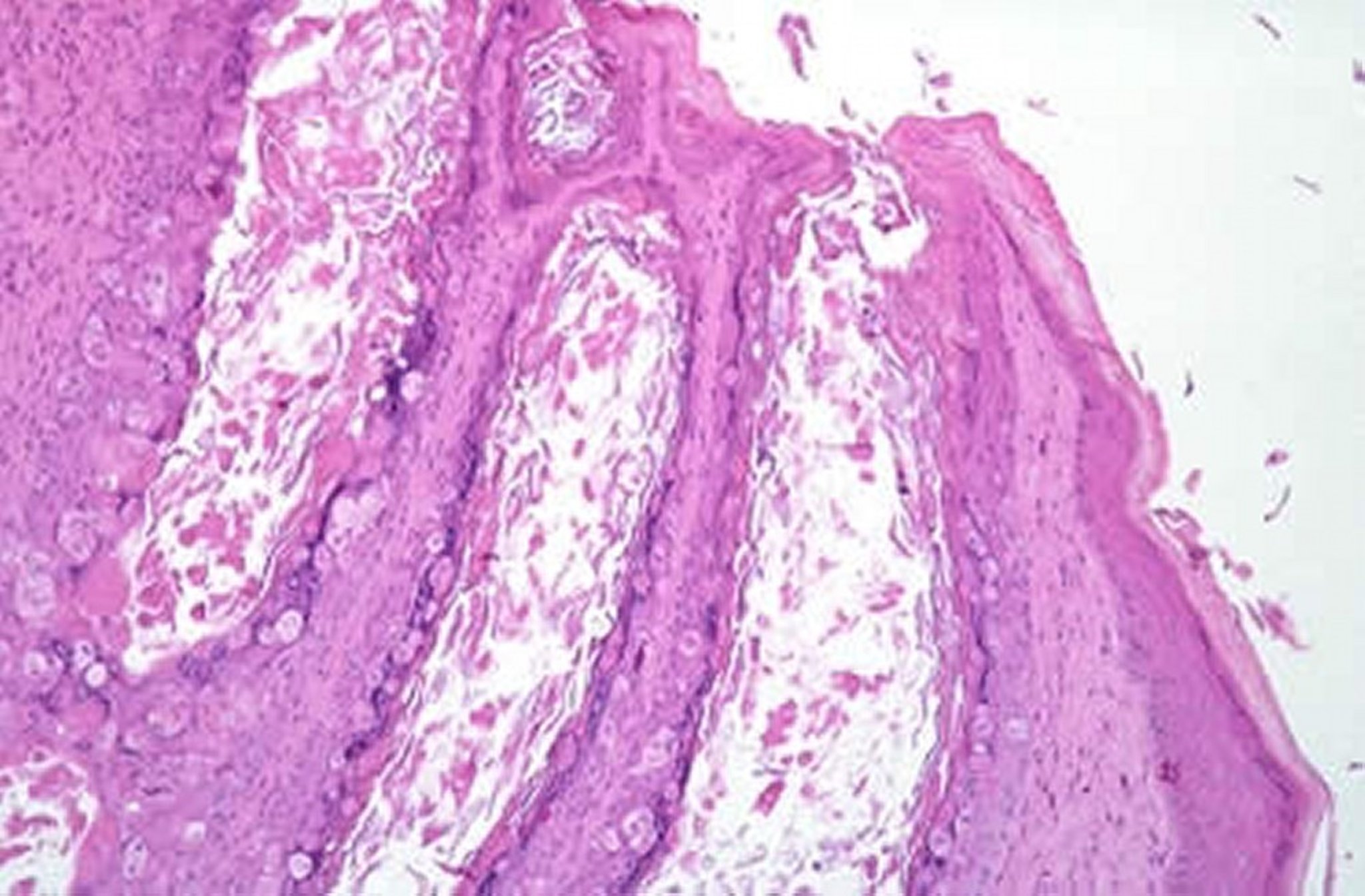 Shope fibroma, rabbit