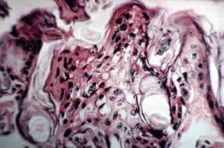Mousepox, inclusion bodies in epidermal cells, mouse