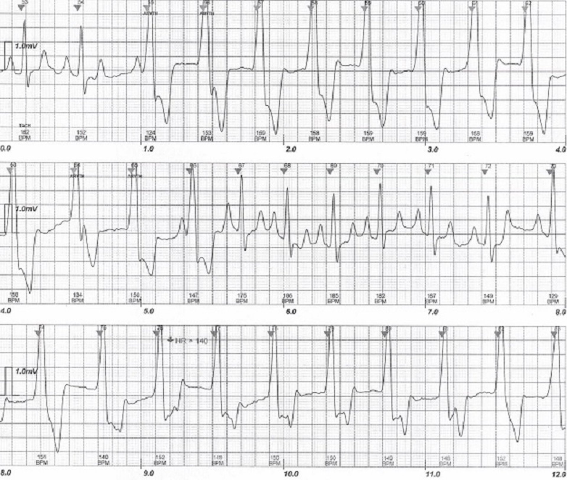 ECG, ritmo idioventricular acelerado, perro