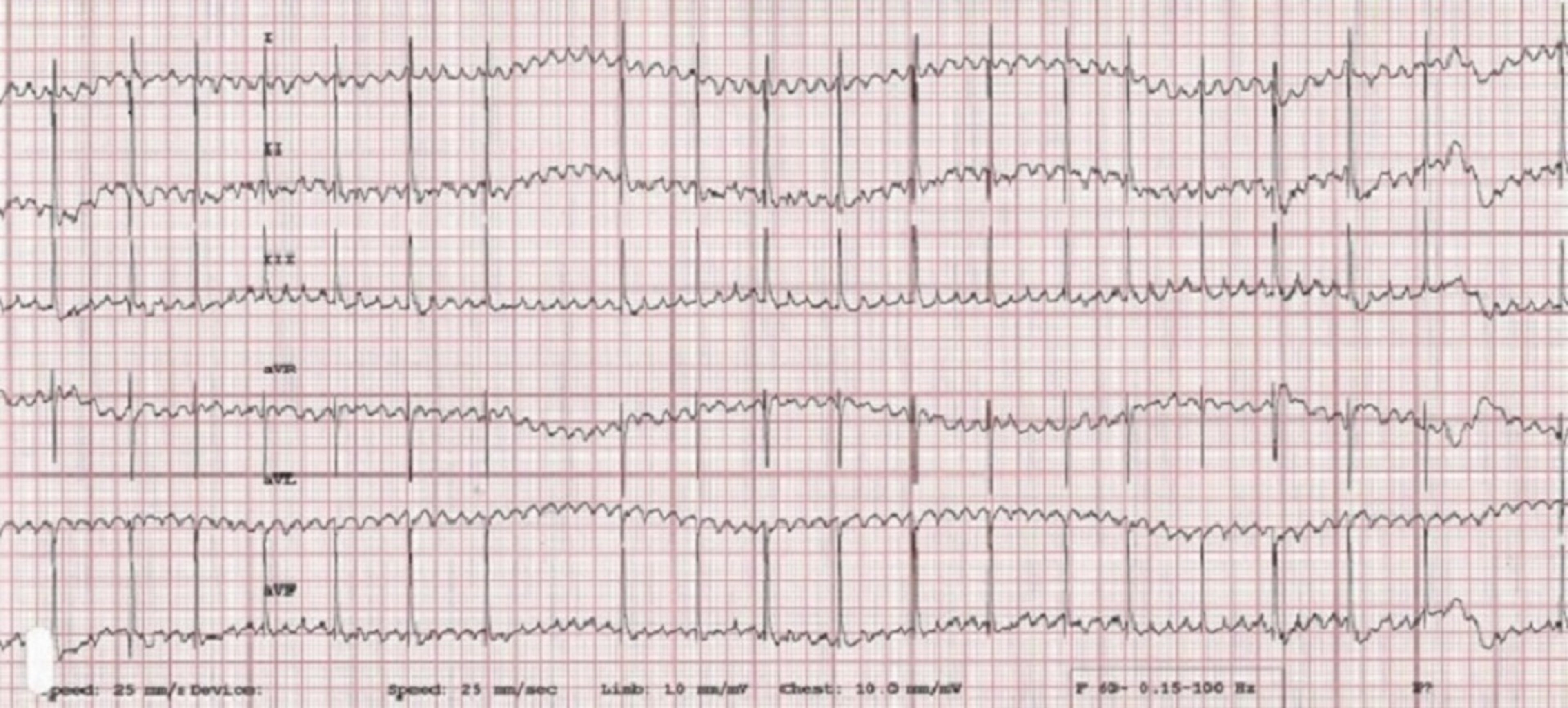 ECG, aleteo auricular, perro