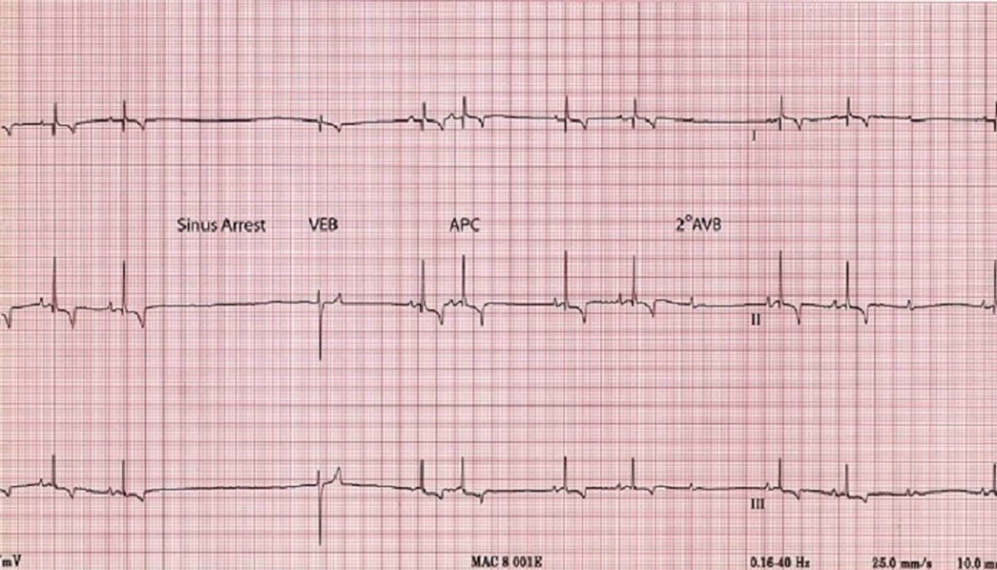 ECG, paro sinusal, perro