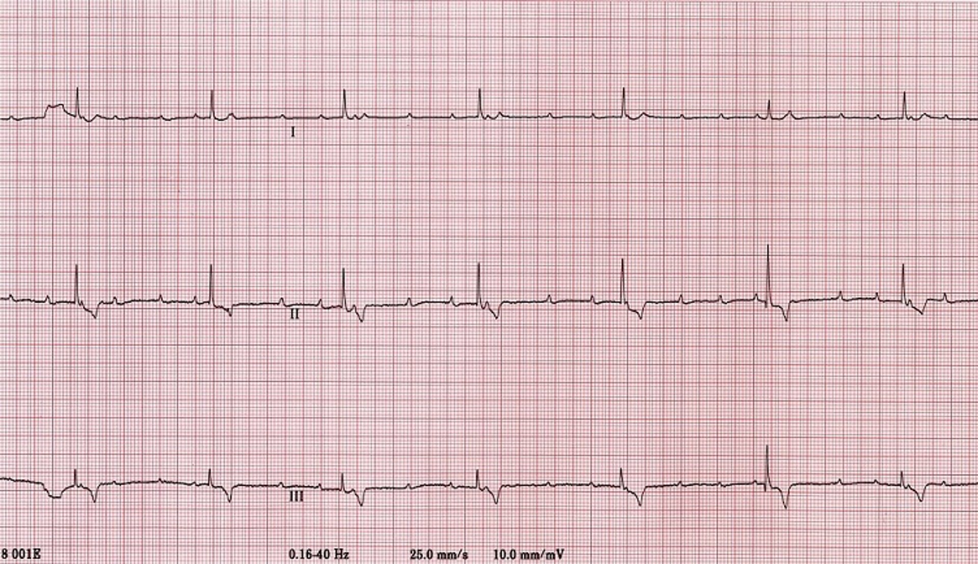 ECG, bloqueo auriculoventricular de tercer grado (completo), perro