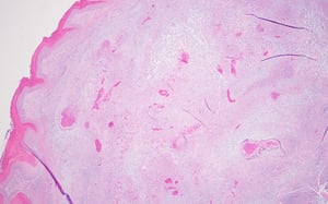 Edema and necrosis, footpad, photomicrograph, poultry