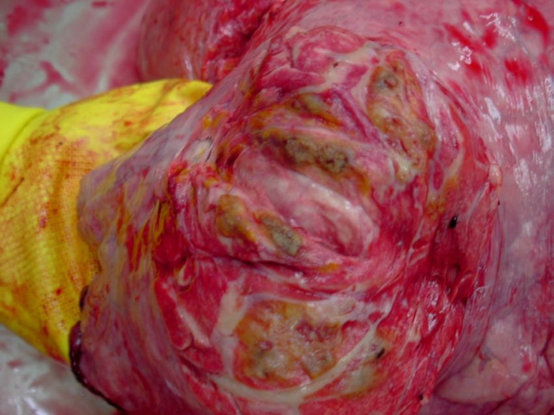 Embolic pneumonia, cow