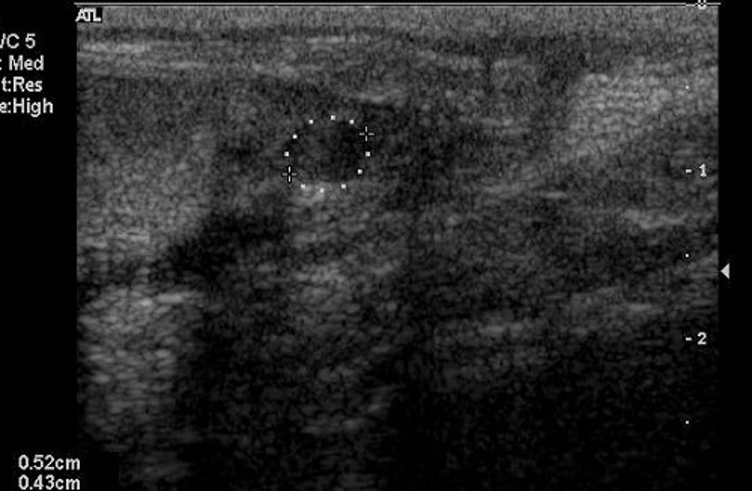 Epididymitis, epididymal abscess, ultrasonogram, dog