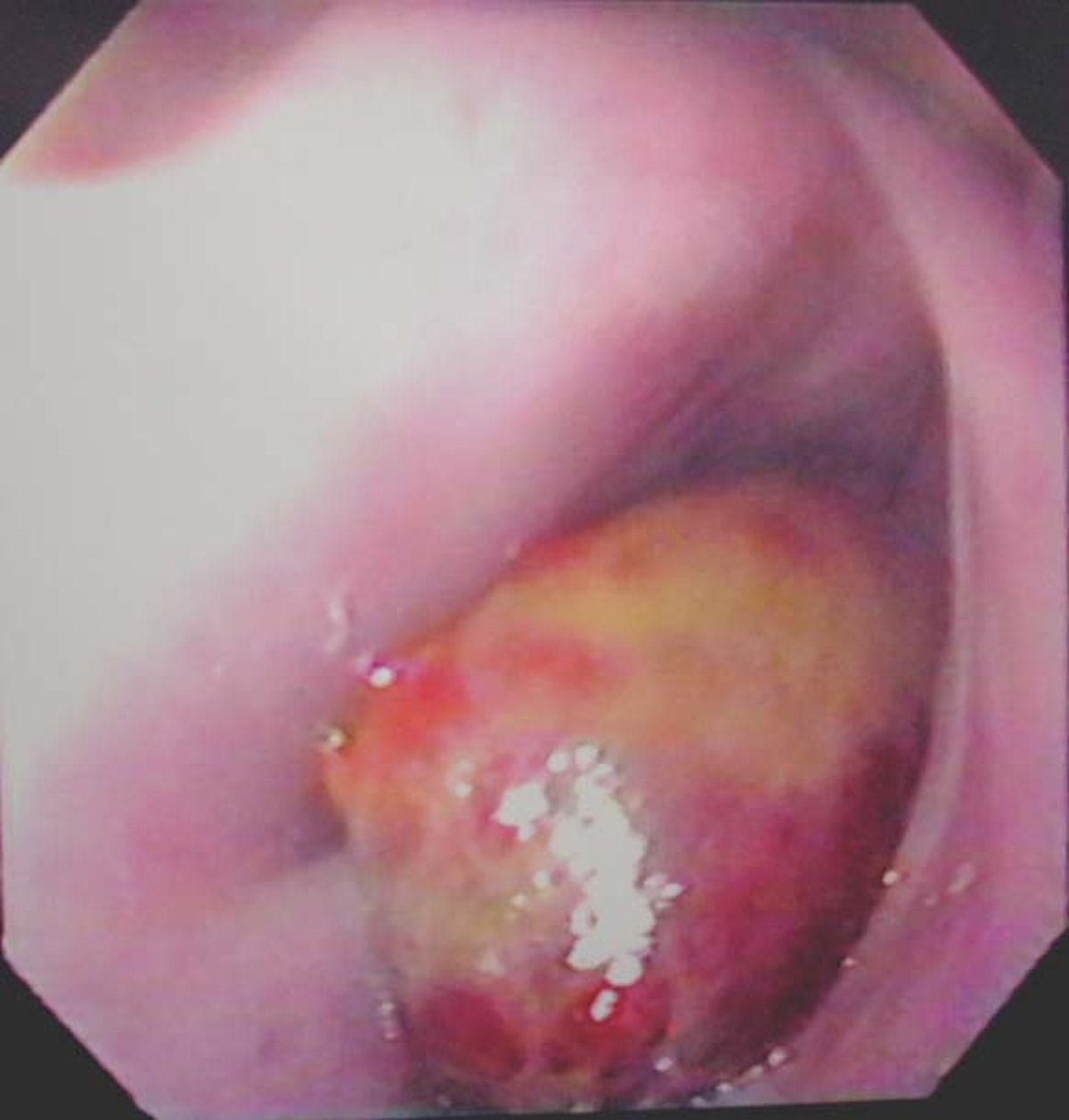 Hematoma etmoidal, caballo