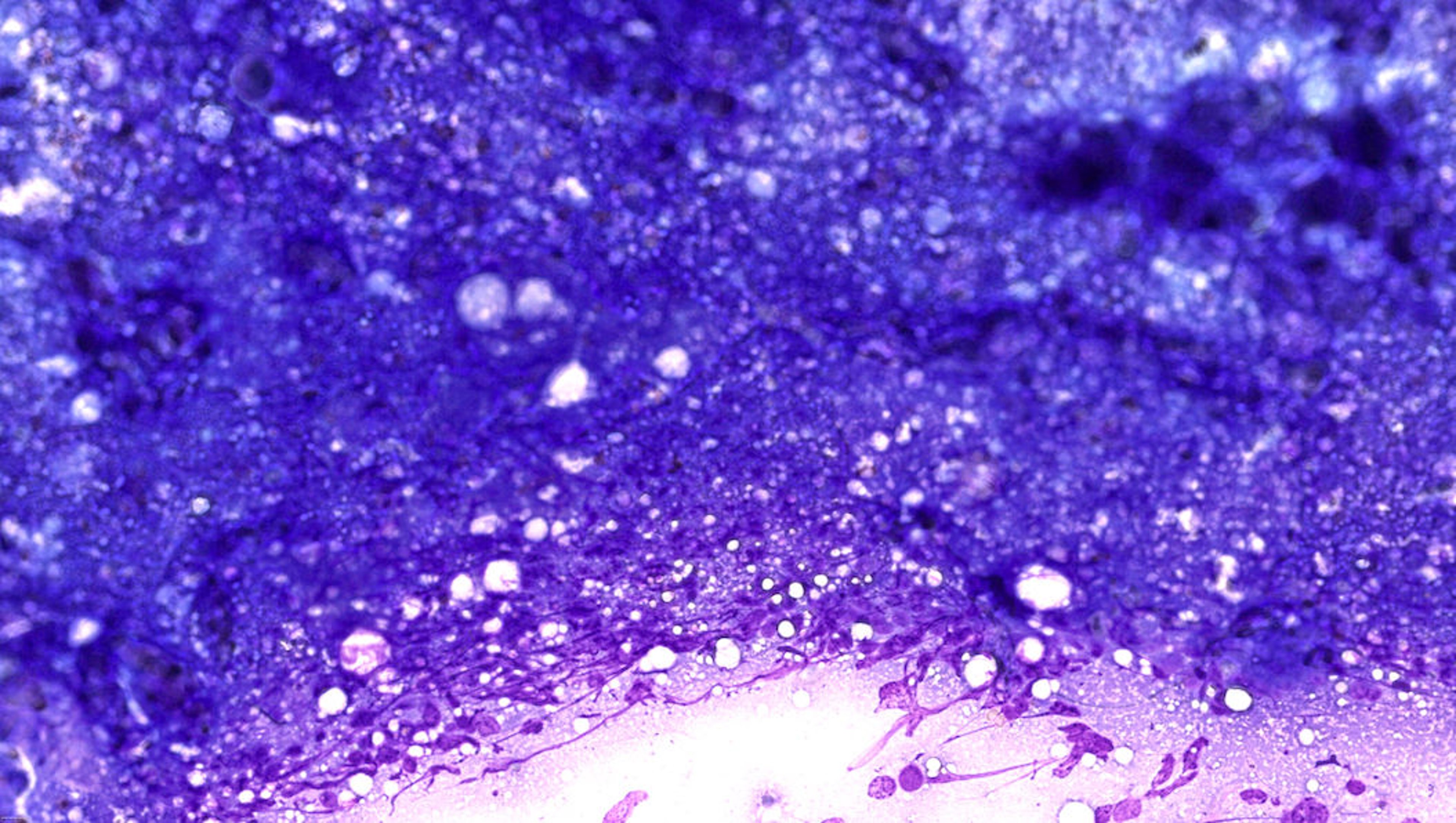 Excessive specimen density, high magnification