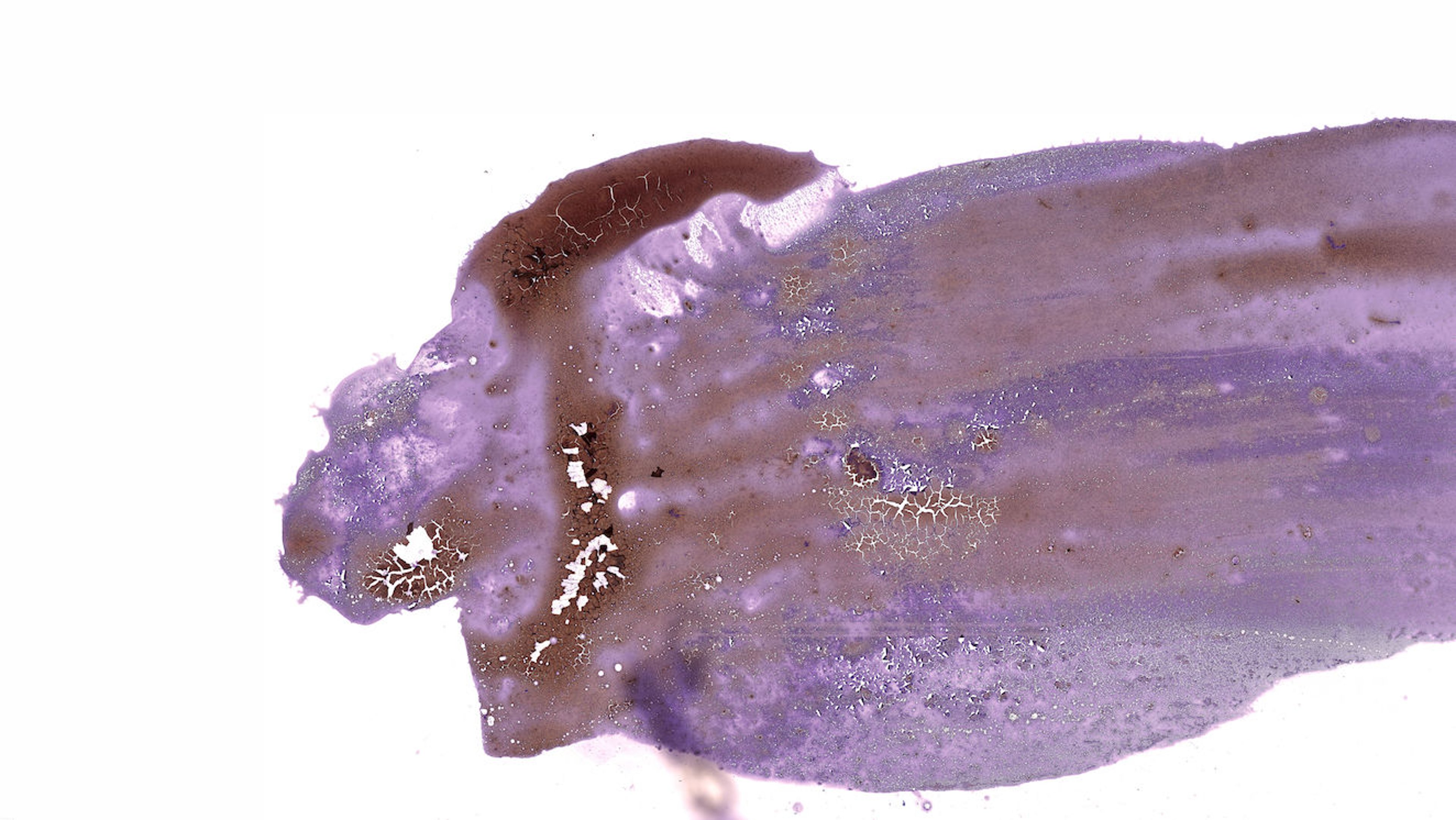 Excessive specimen density, low magnification