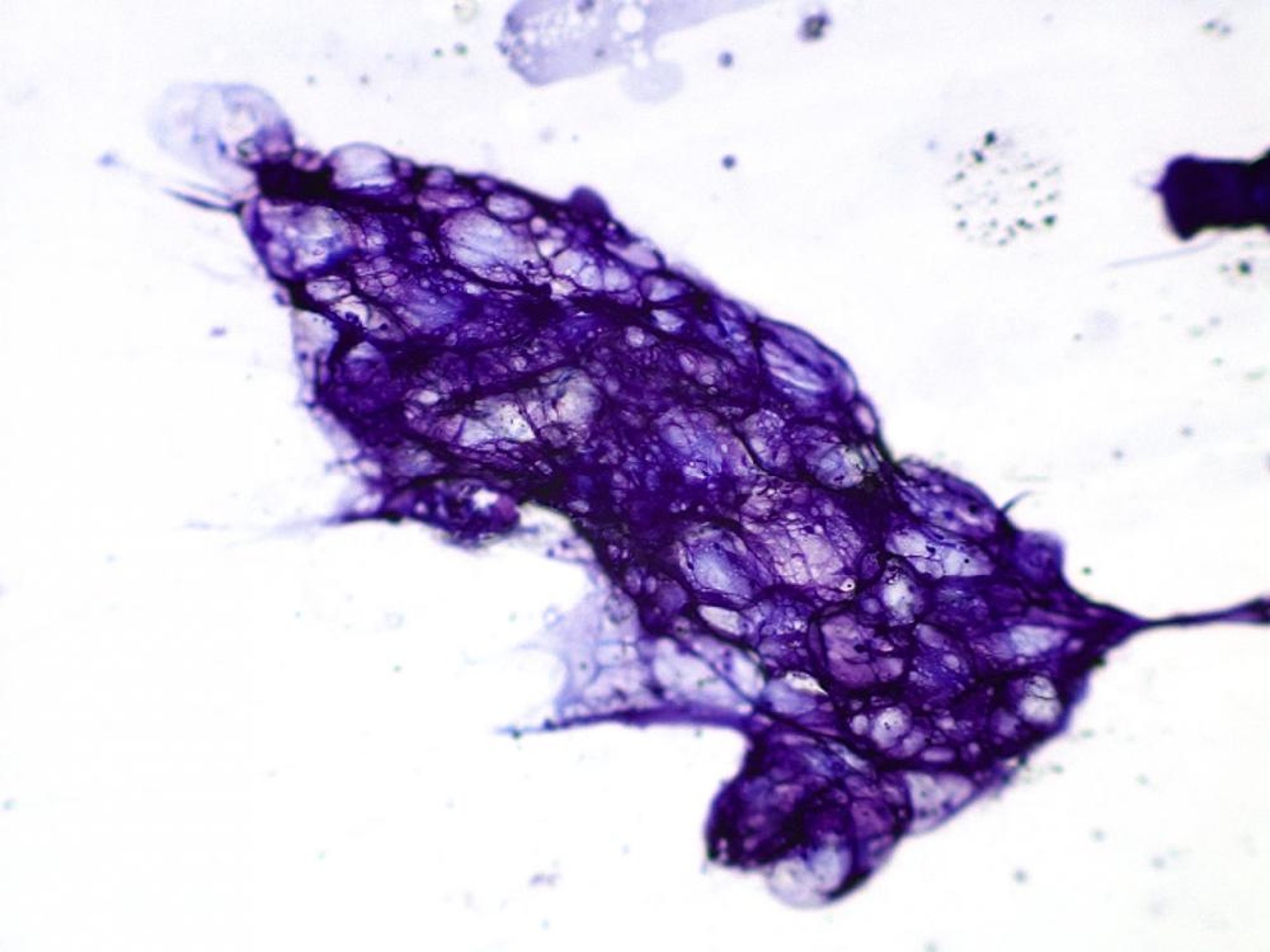 Fat cells, folded and overlapping, cytology