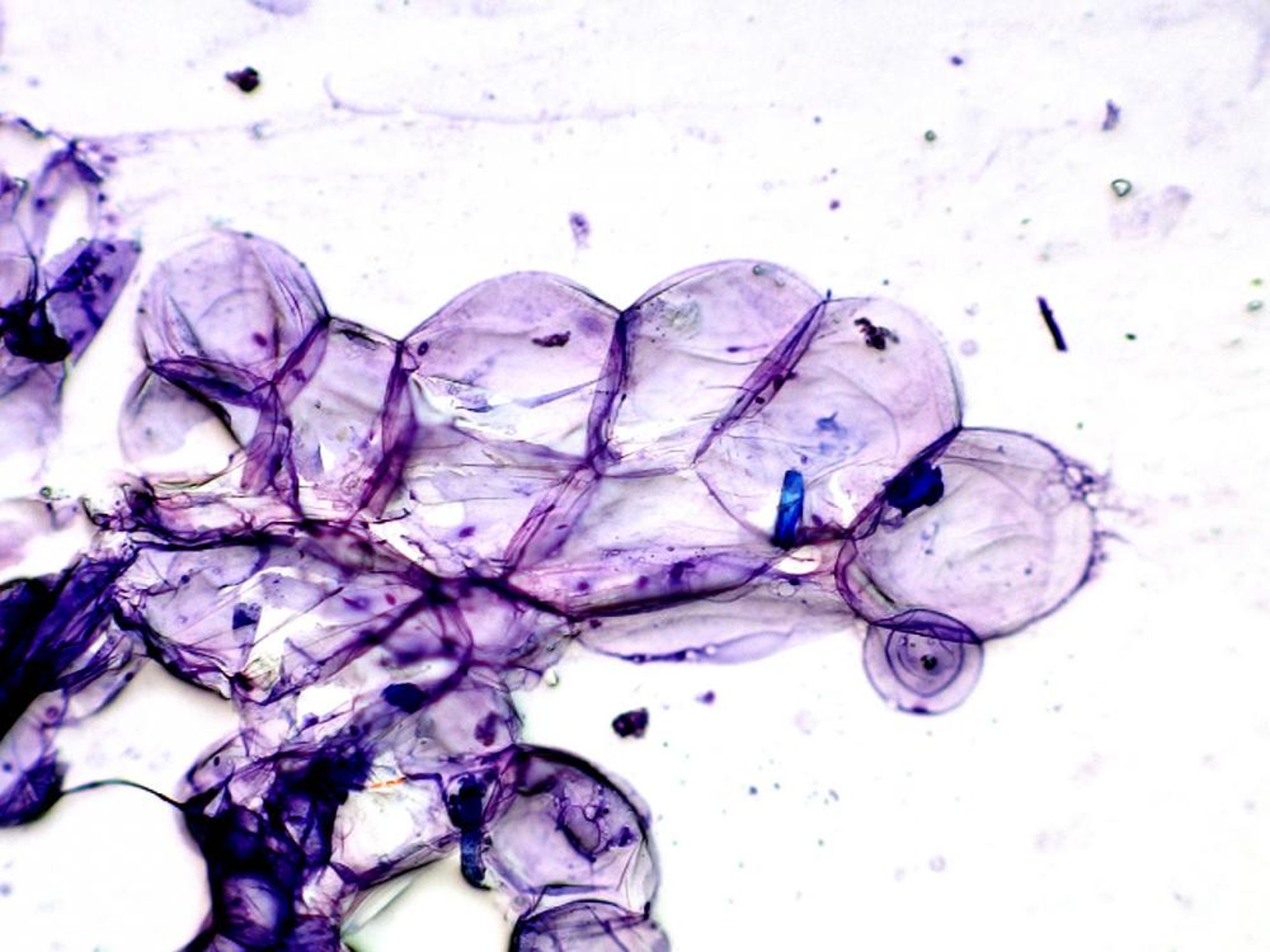 Fat cells, typical balloon-like, cytology