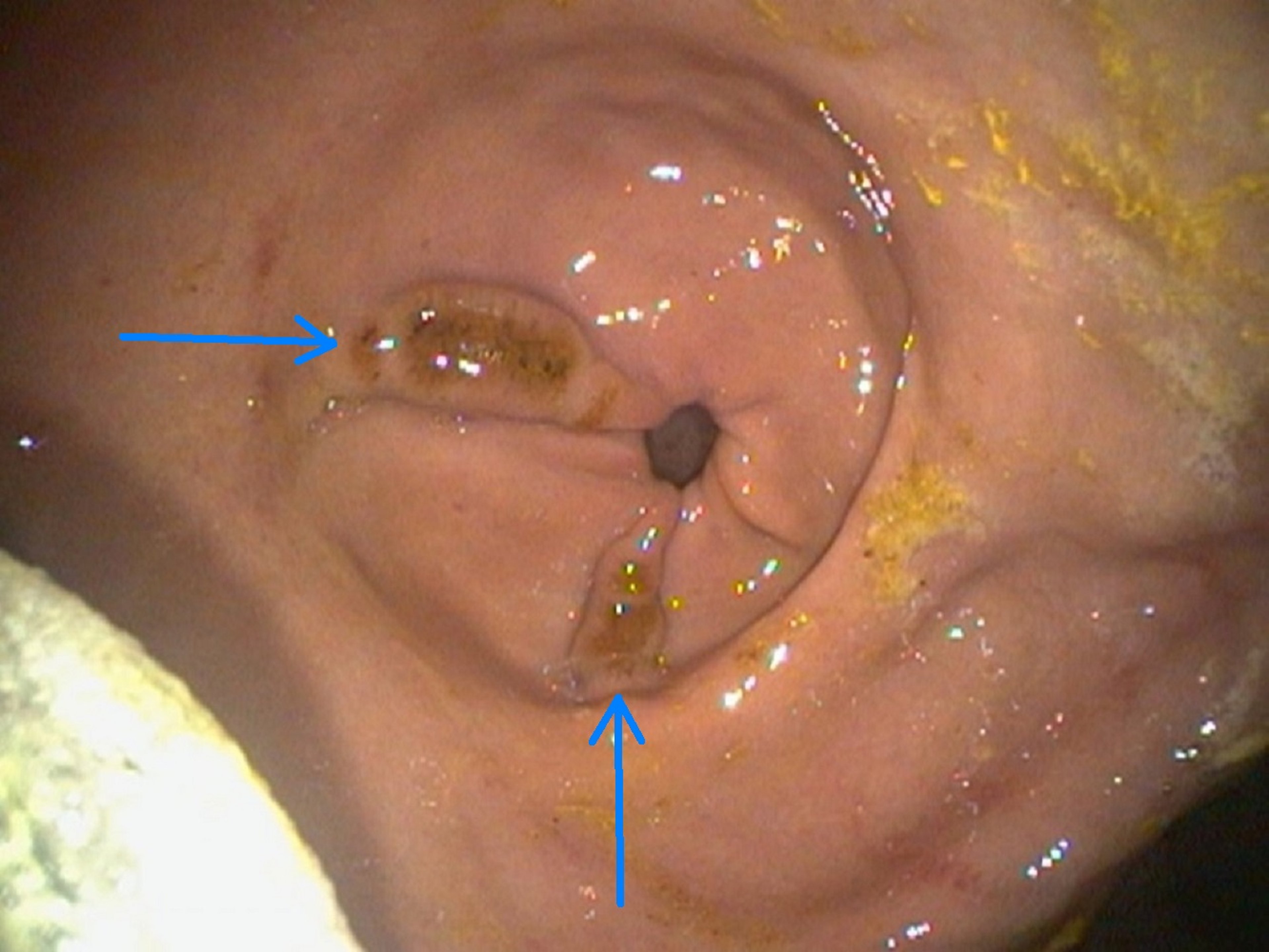 Fibrinosuppurative ulcers, glandular mucosa, adult horse
