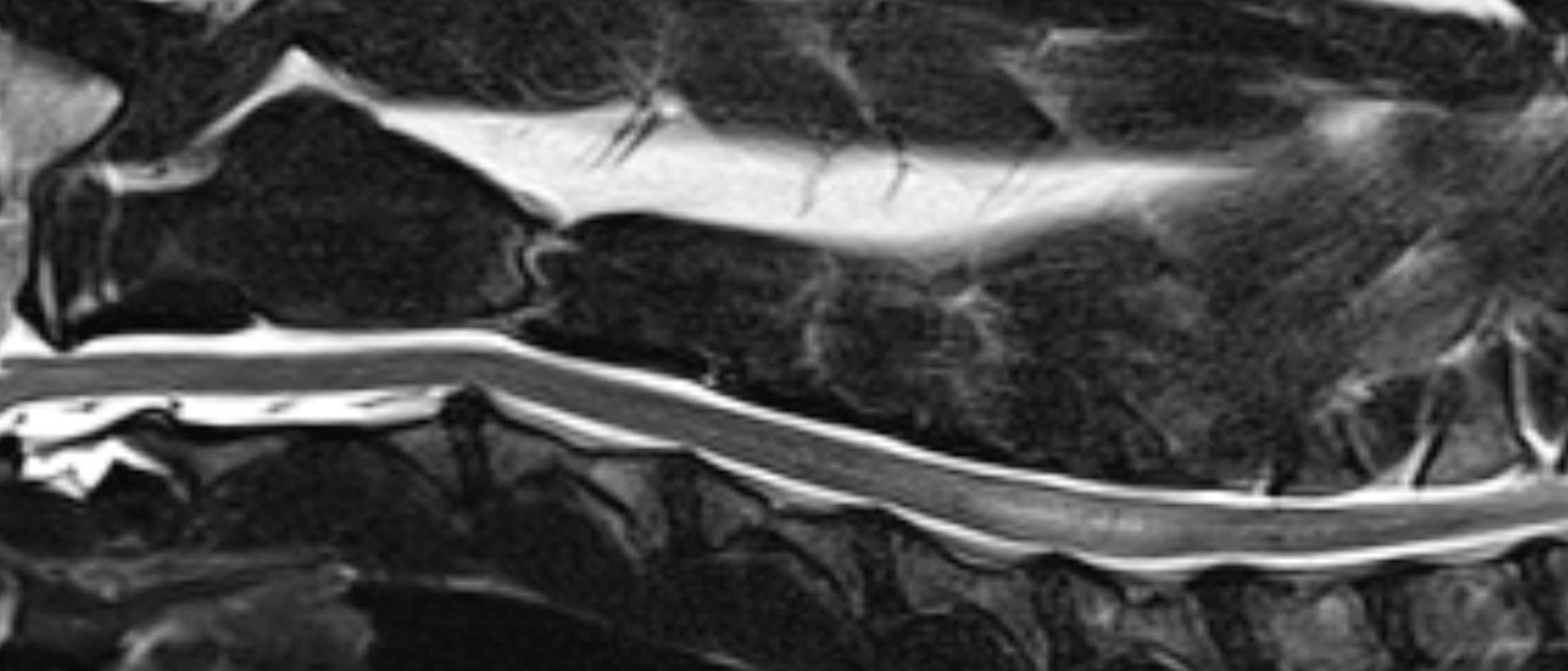 Fibrocartilaginous embolism, dog