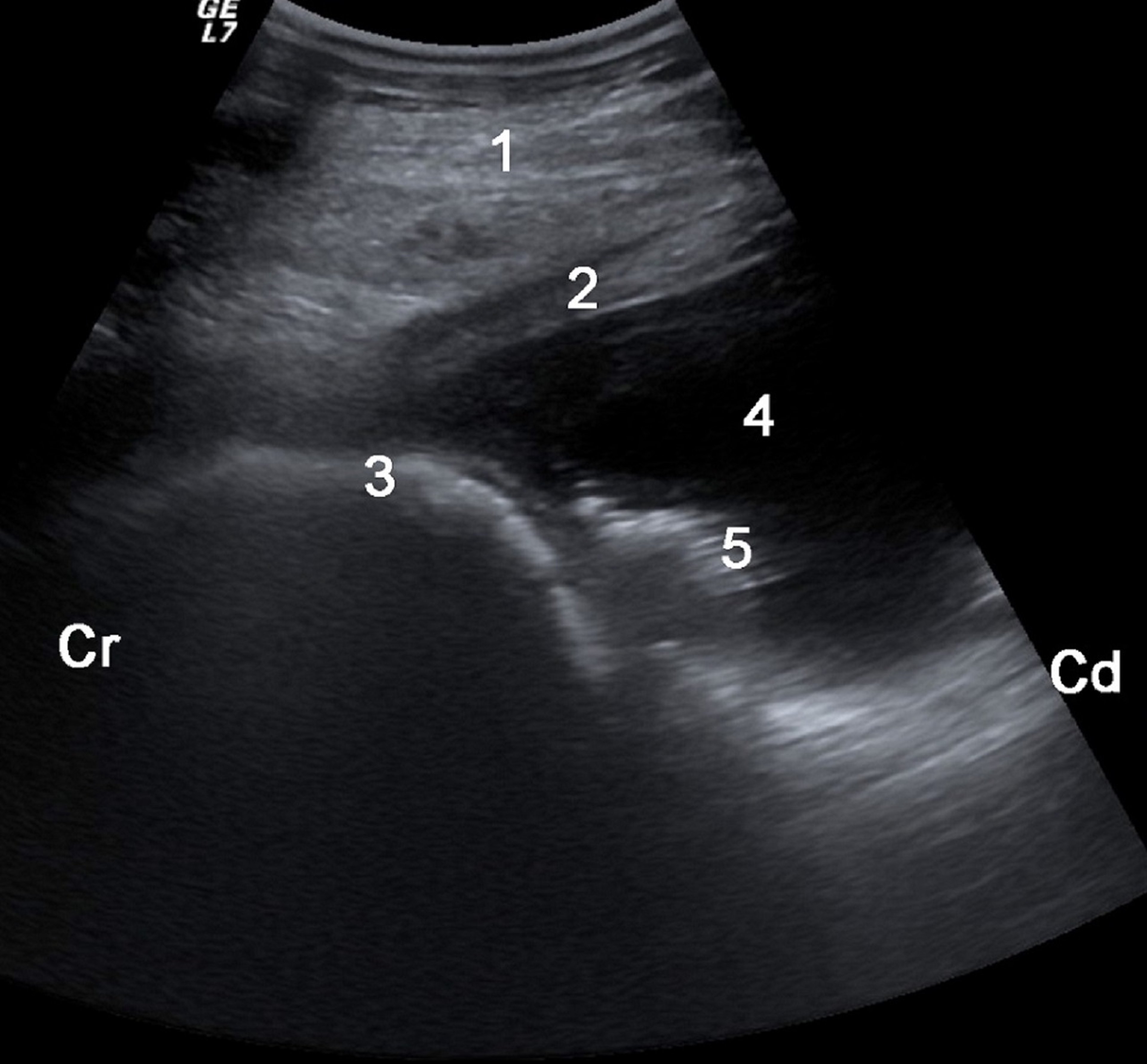 Fluid accumulation in traumatic reticuloperitonitis, cow