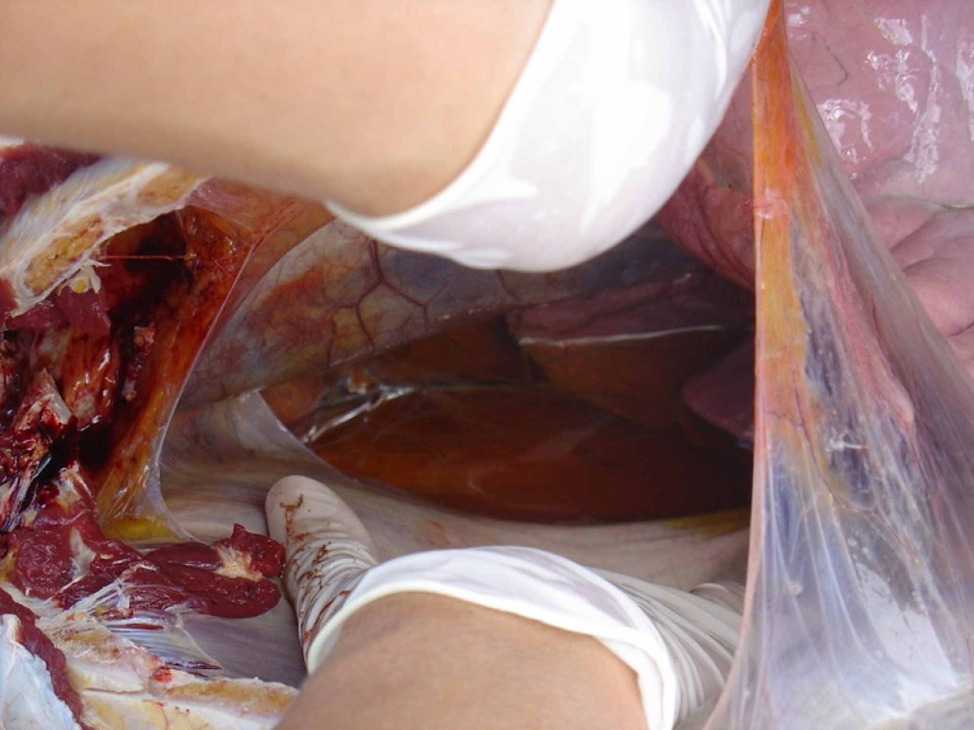 Fluid in pleural cavity, AHS