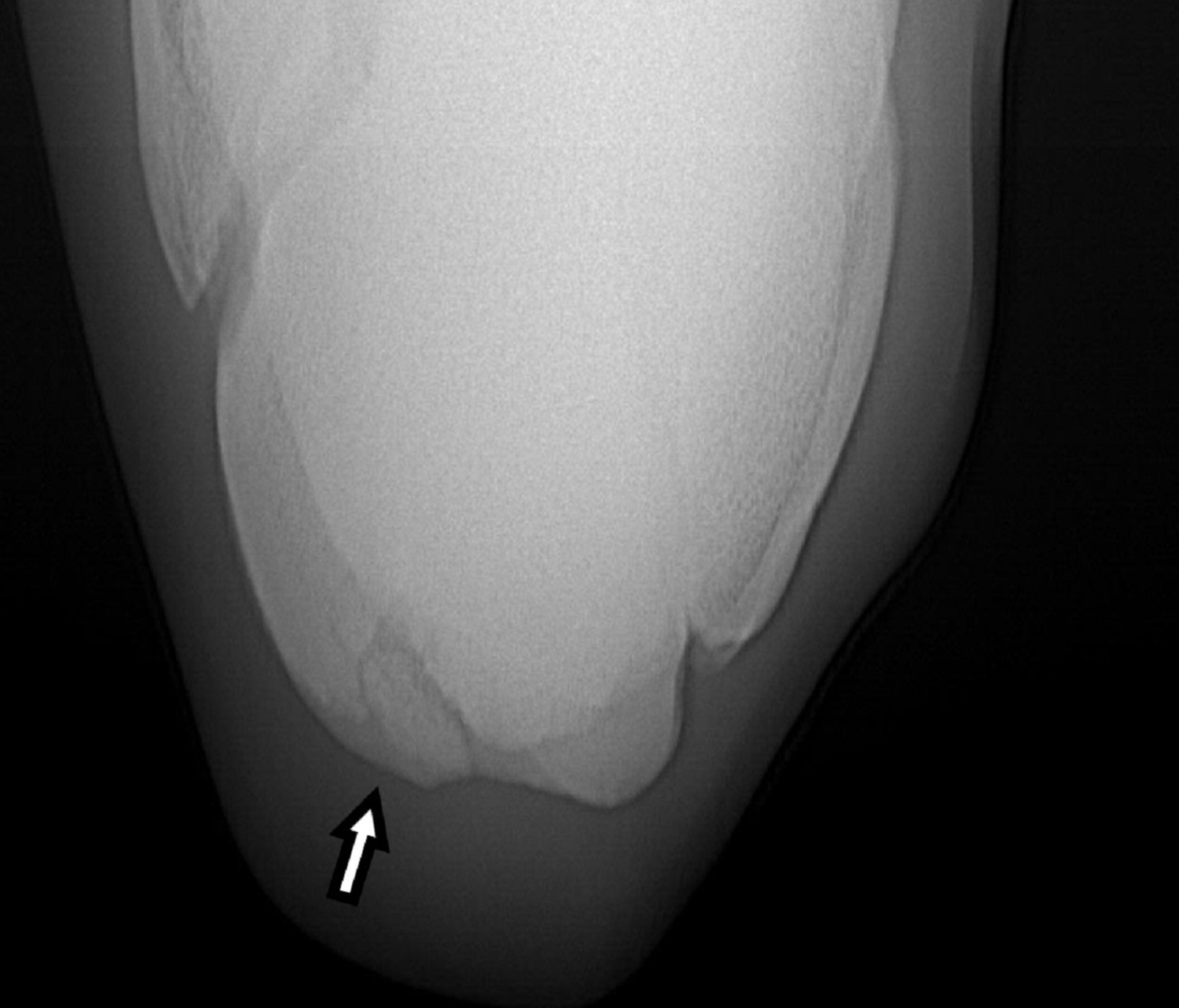 Fracture, third carpal bone, horse
