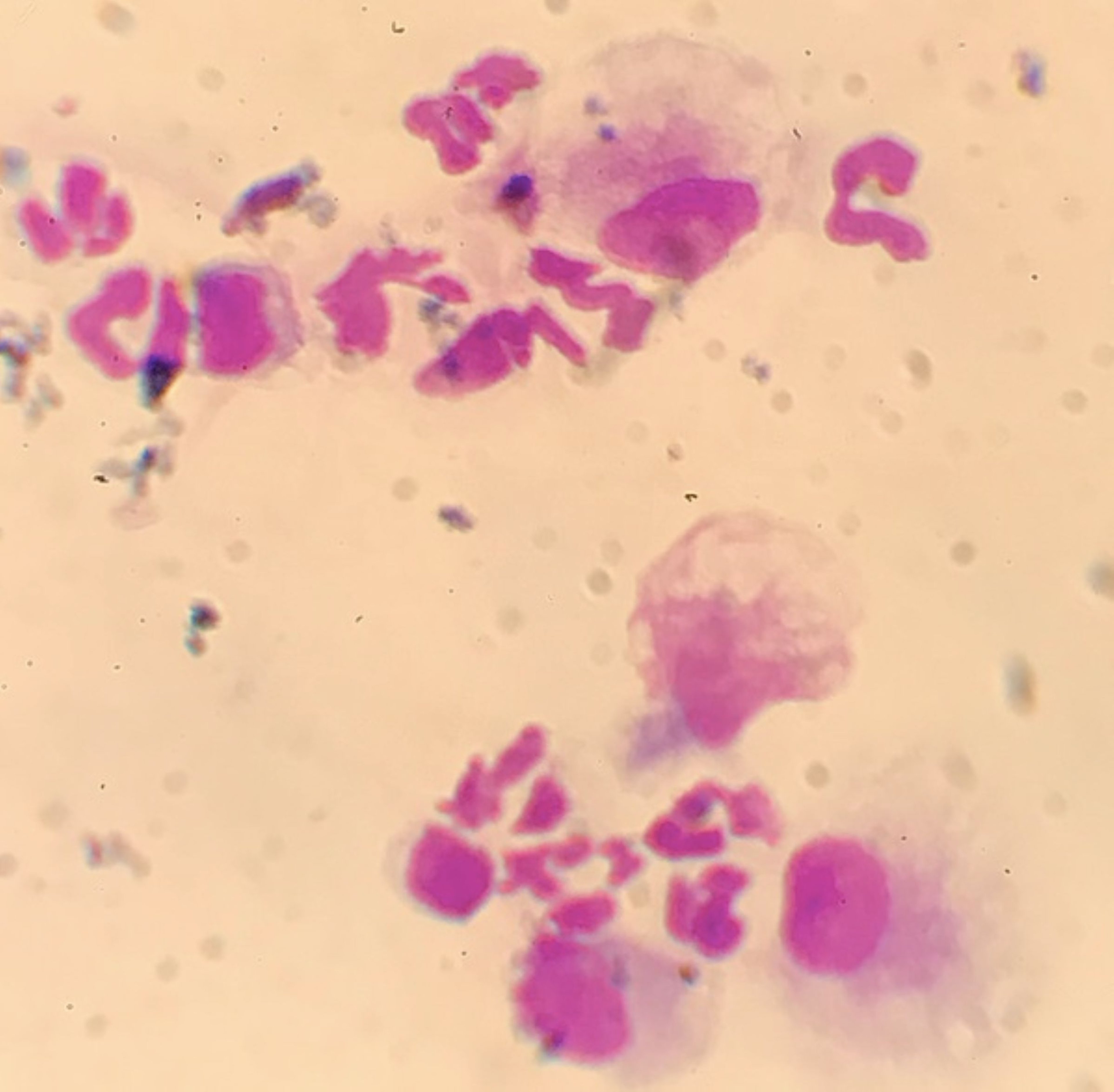 Feline infectious peritonitis, effusion, cytological image