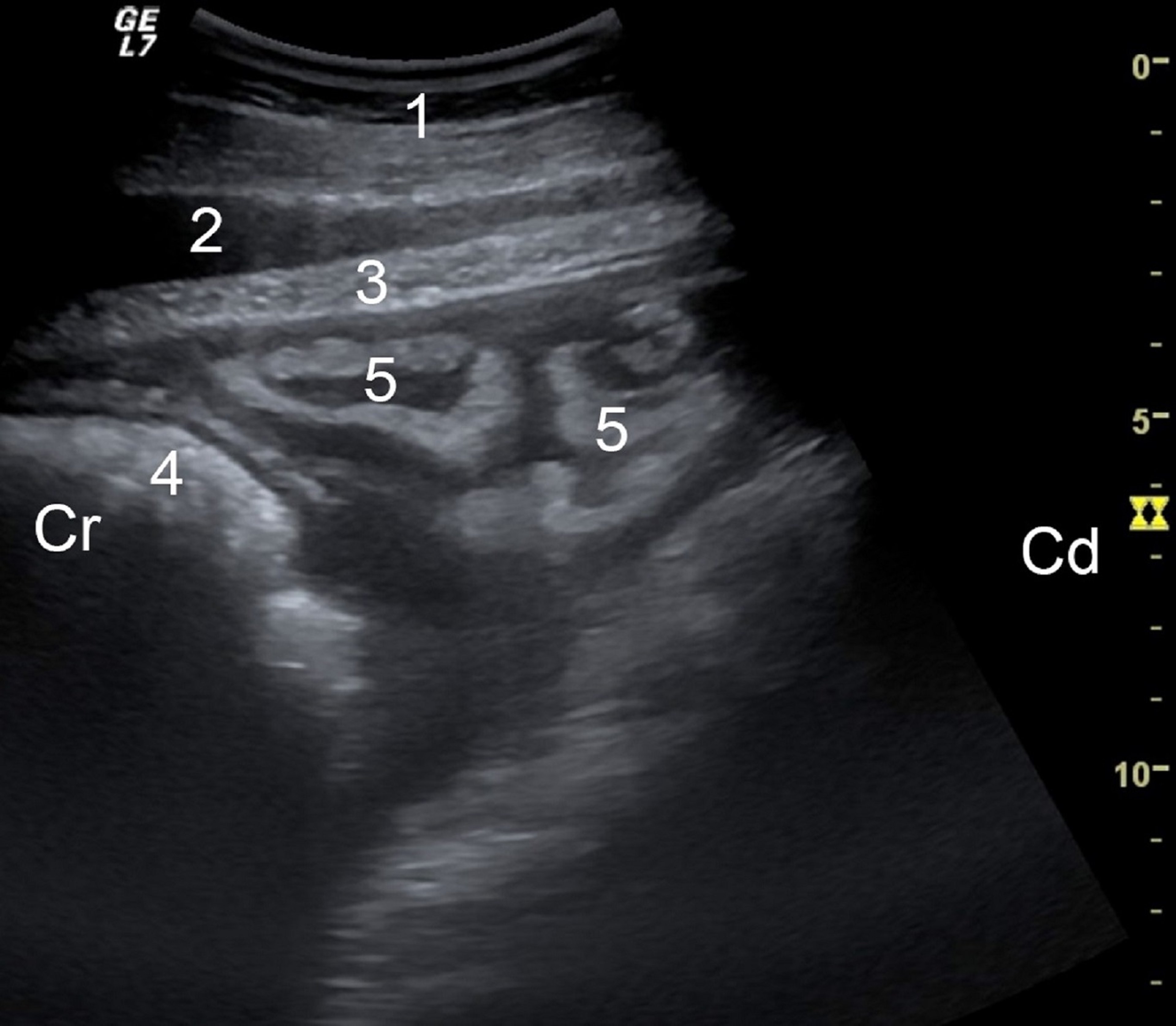 Acumulación de fibrina en la reticuloperitonitis traumática, vaca