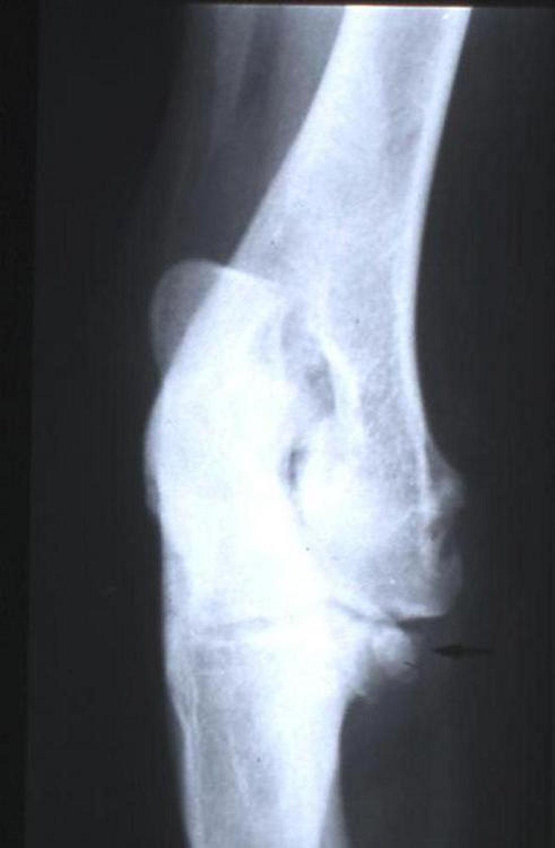 Proceso coronoides medial fragmentado