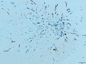 Hifas fúngicas (cerebro), aspergilosis, pavipollo