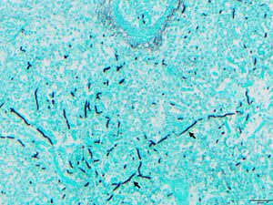 Fungal hyphae (lung), aspergillosis, turkey poult