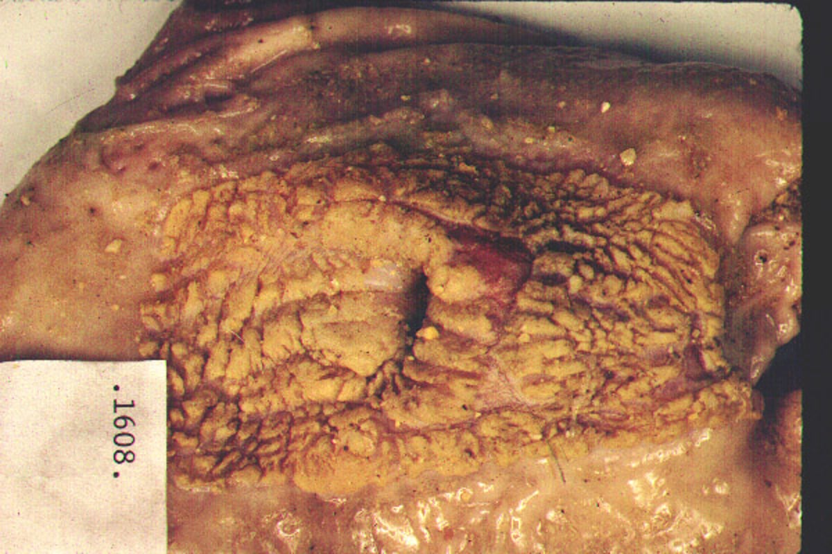 Gastric ulcer with parakeratosis, pig