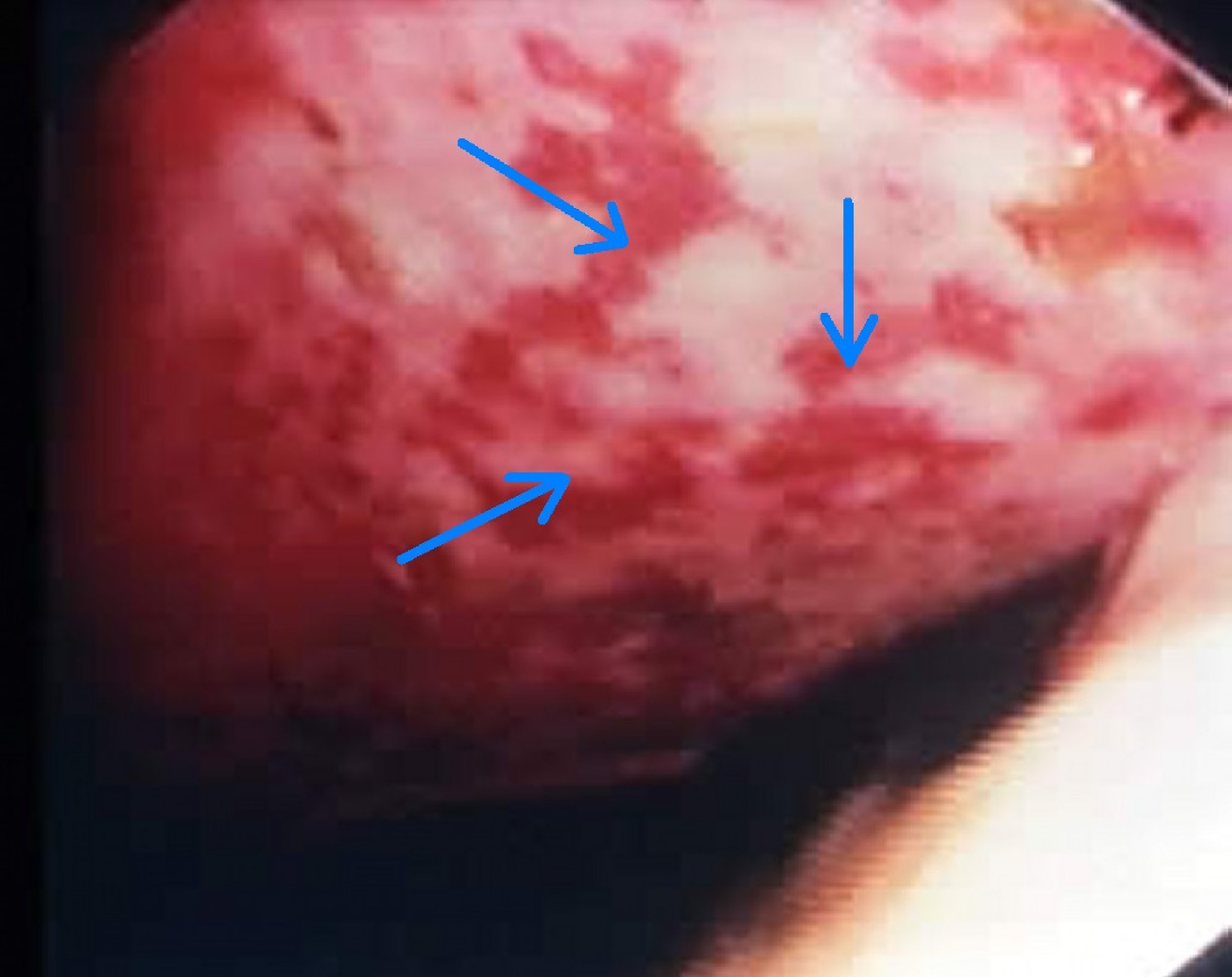 Gastric ulcers, foal