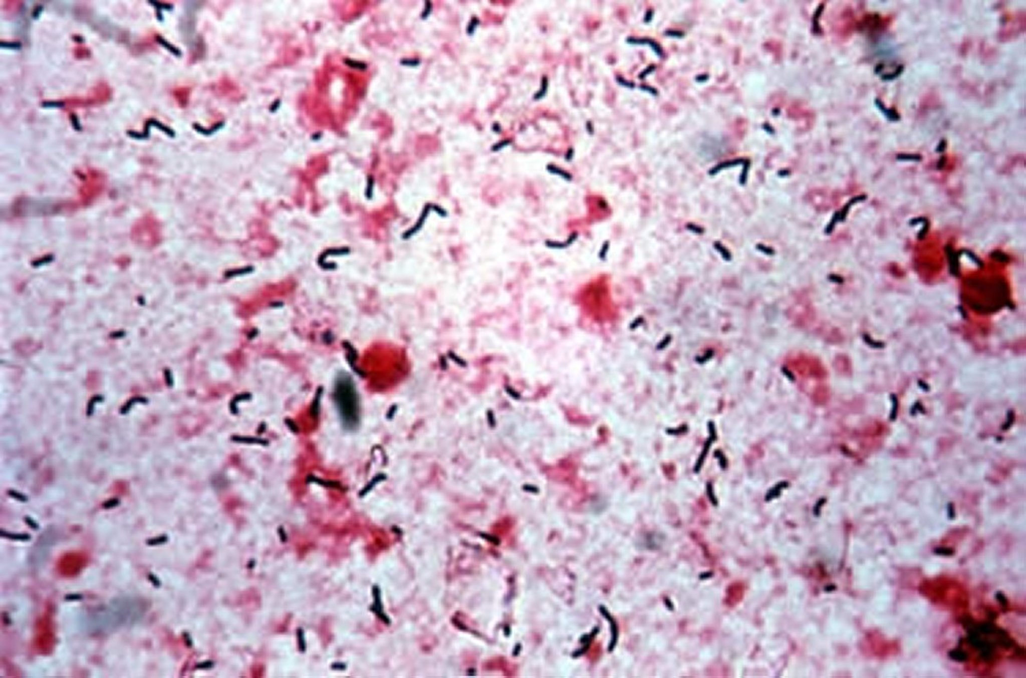 <i >Listeria monocytogenes</i>, photomicrograph of brain stem post-mortem specimen