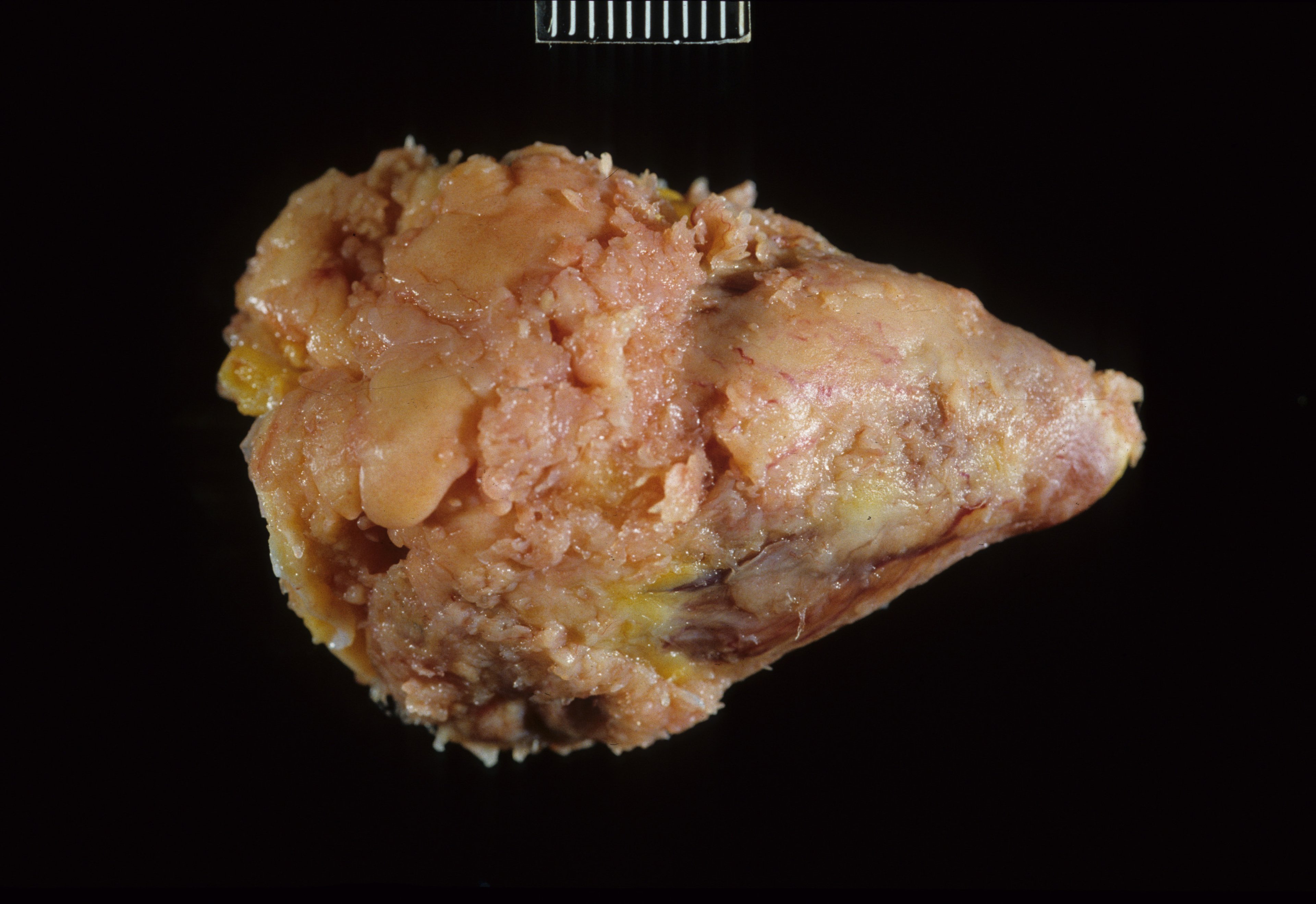 Granulomatous pericarditis, adult chicken
