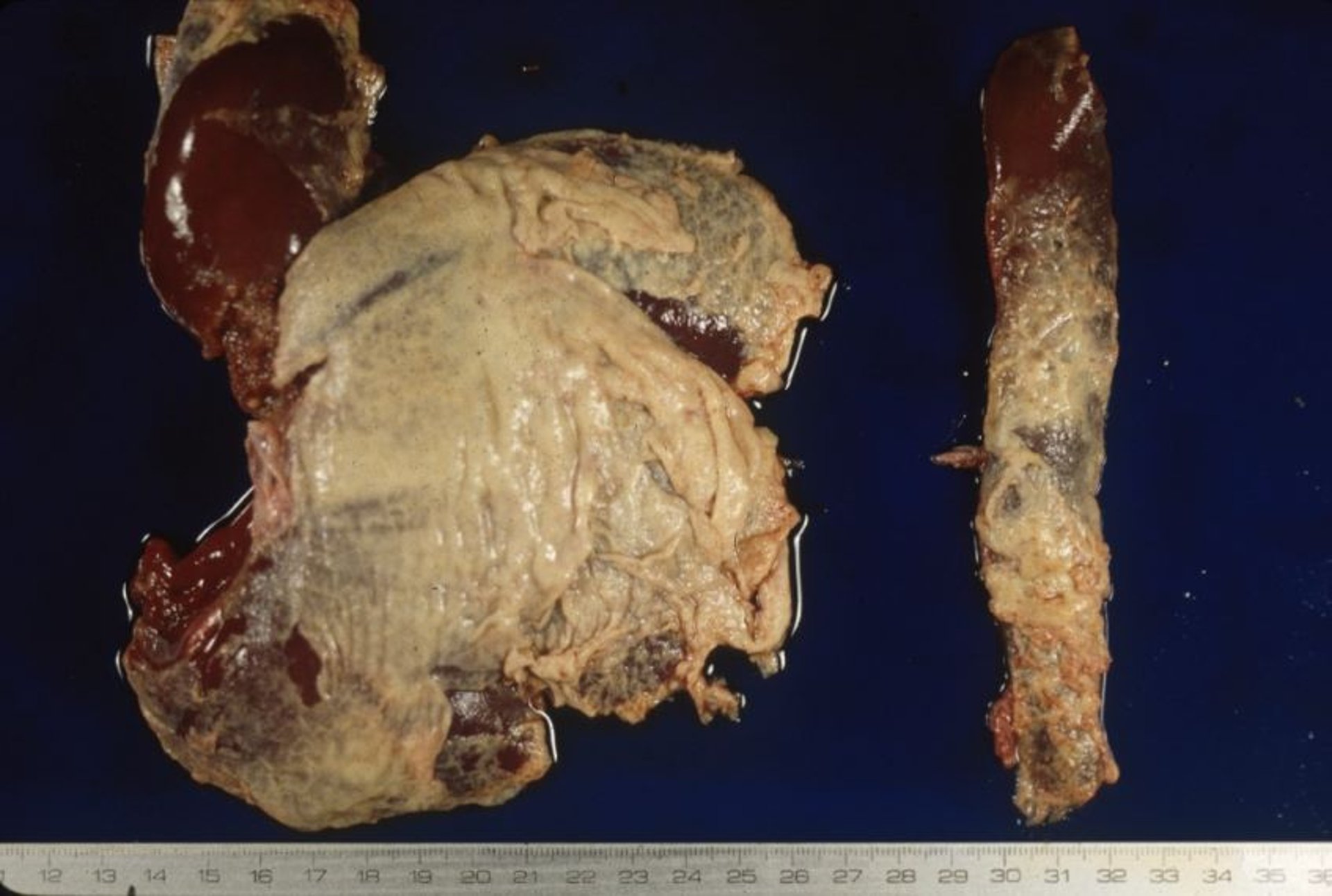 Glässer disease, perihepatitis and perisplenitis, pig